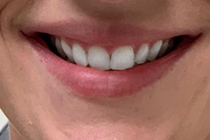 Lip After Lip After