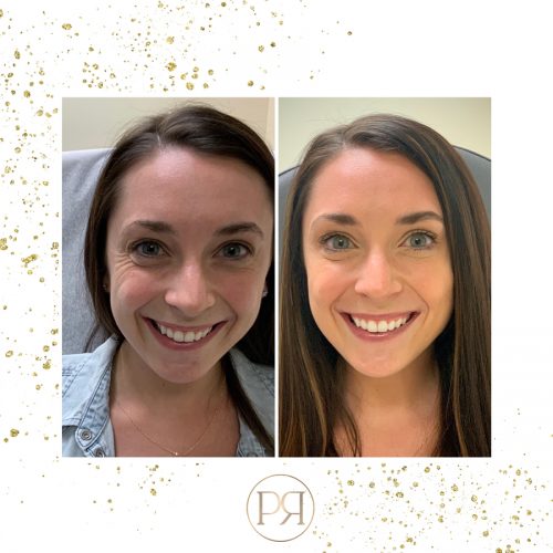 KT Before And After Gold Specs2